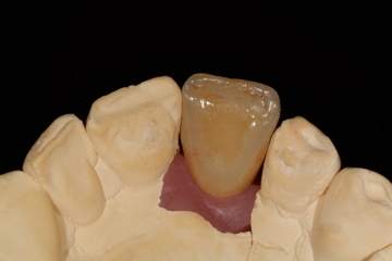 EMAX Implant Central 5