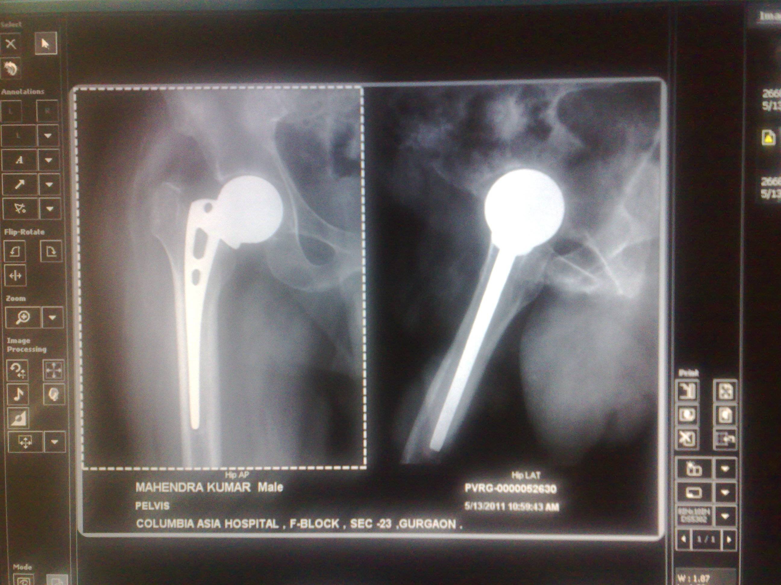 Loose Hip Implant