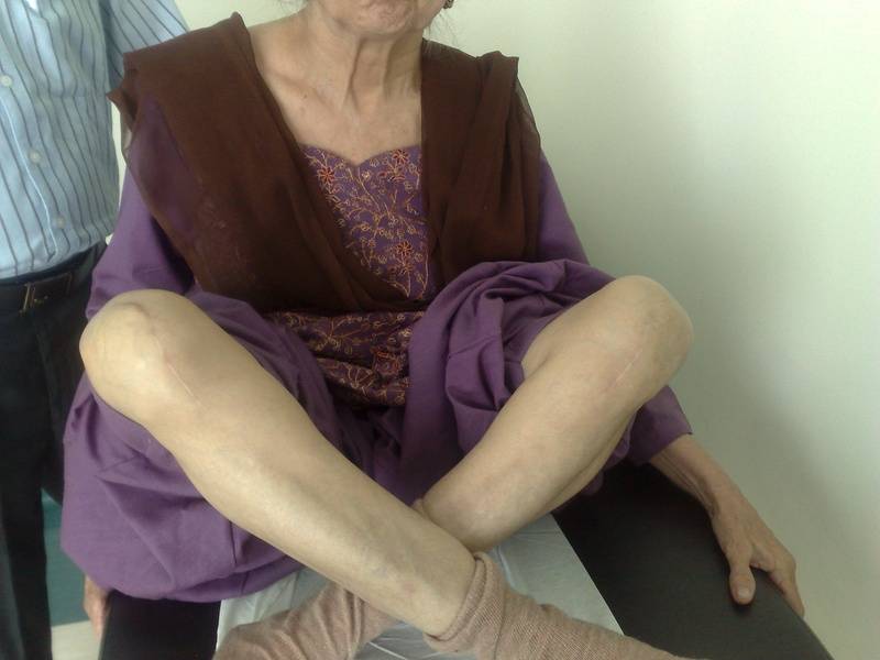 Knee bending after Joint replacement surgery in Gurgaon