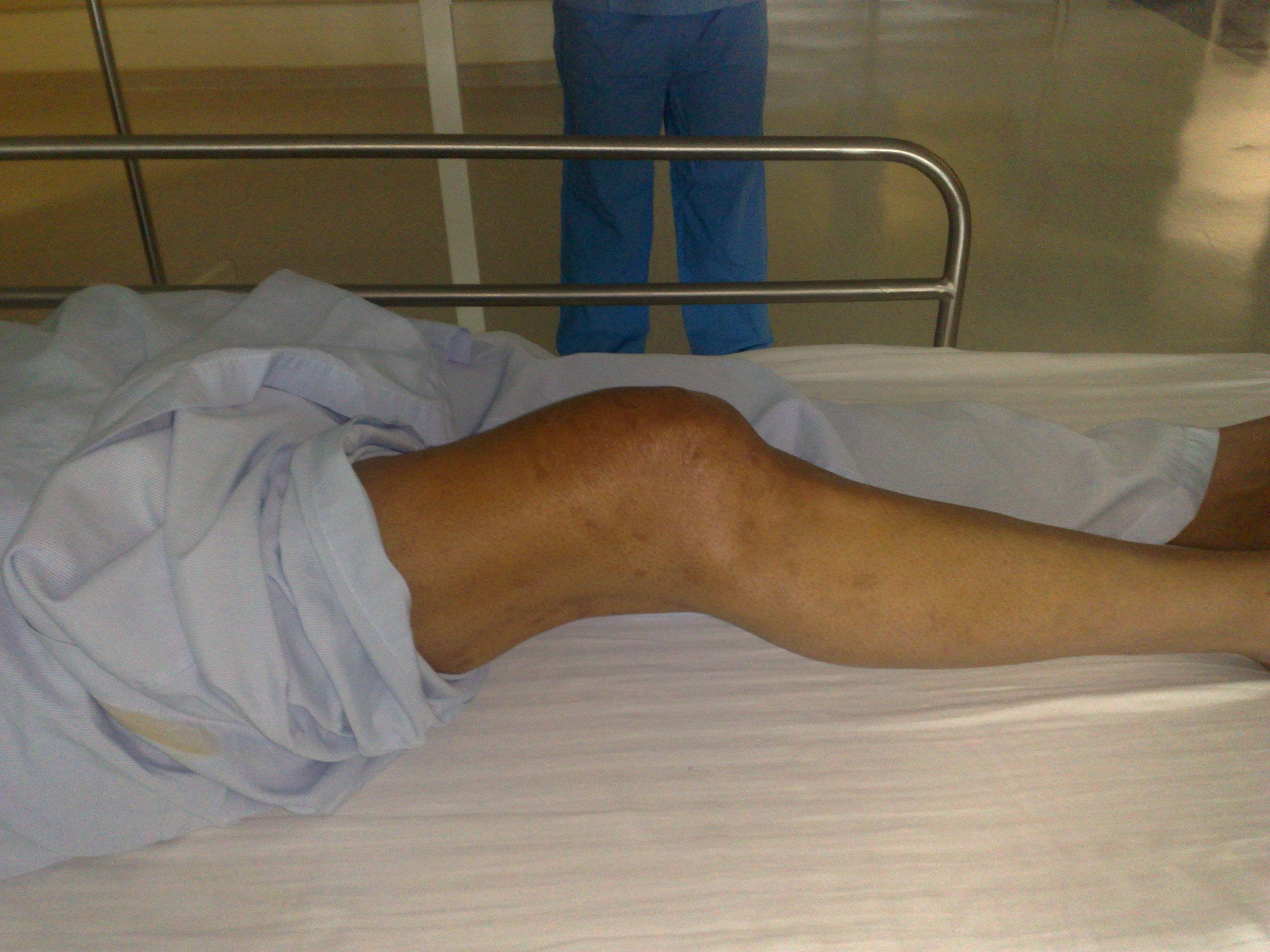 Flexion deformity of the knee