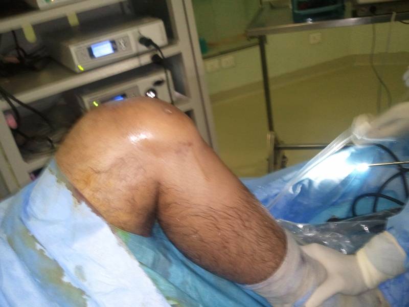 Arthroscopic surgery for stiff Knee